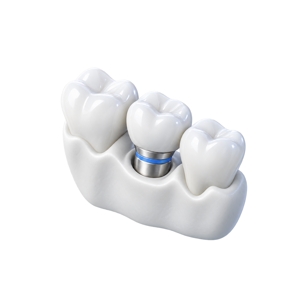 3D-иконка имплантации